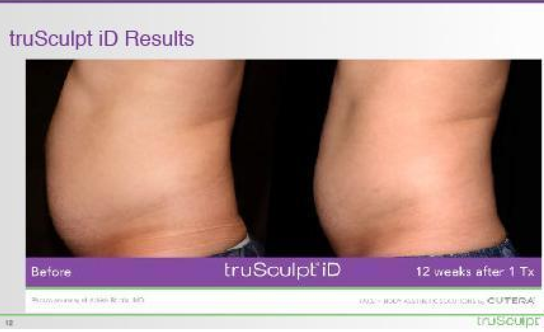 trusculpt gynecologist near me