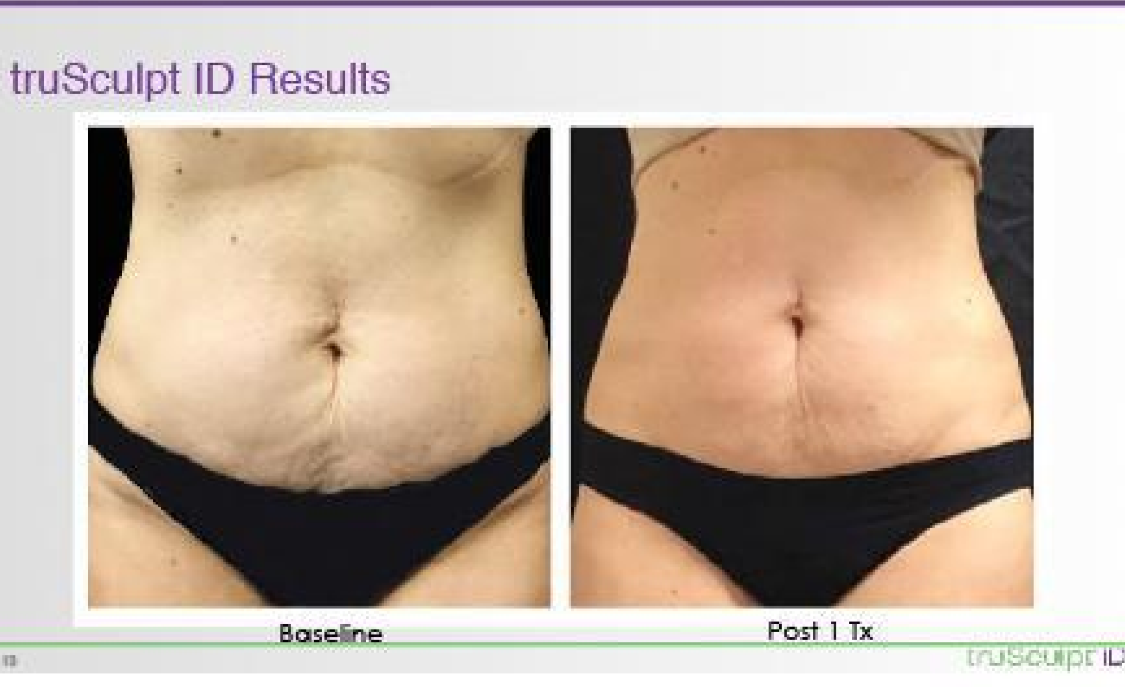 trusculpt ob near me