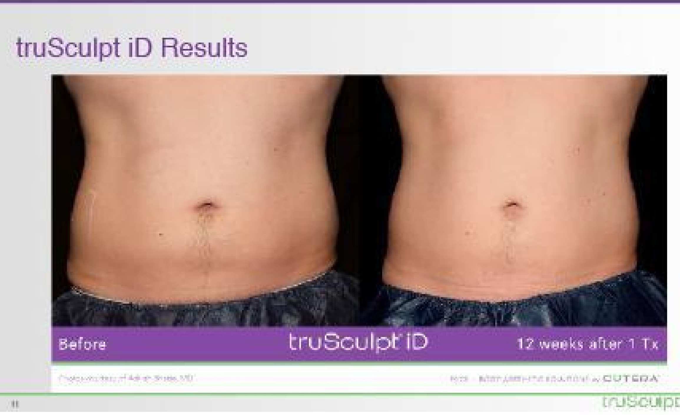 trusculpt ob near me