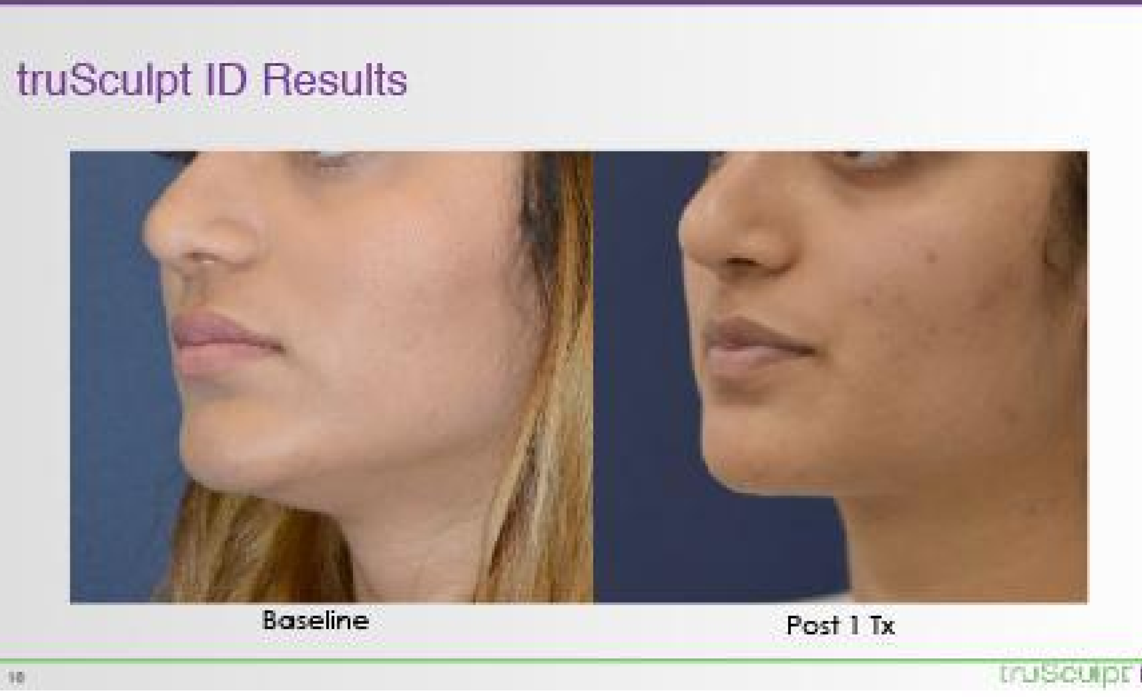 trusculpt obgyn near me