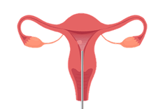 MyoSure-Step-1-insert-and-identify