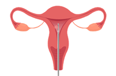 MyoSure-Step-2-access-tissue