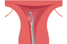 MyoSure-Step-3-remove-tissue