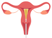 NovaSure-Step-1-insertion