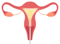 NovaSure-Step-3-ablation