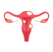 uterine-fibroids-img